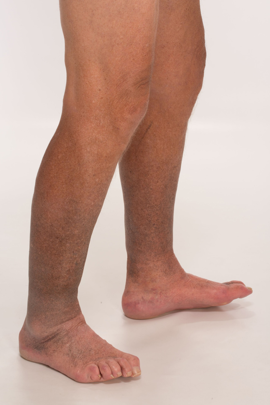 a-77-year-old-with-cutaneous-hyperpigmentation-and-lower-extremity